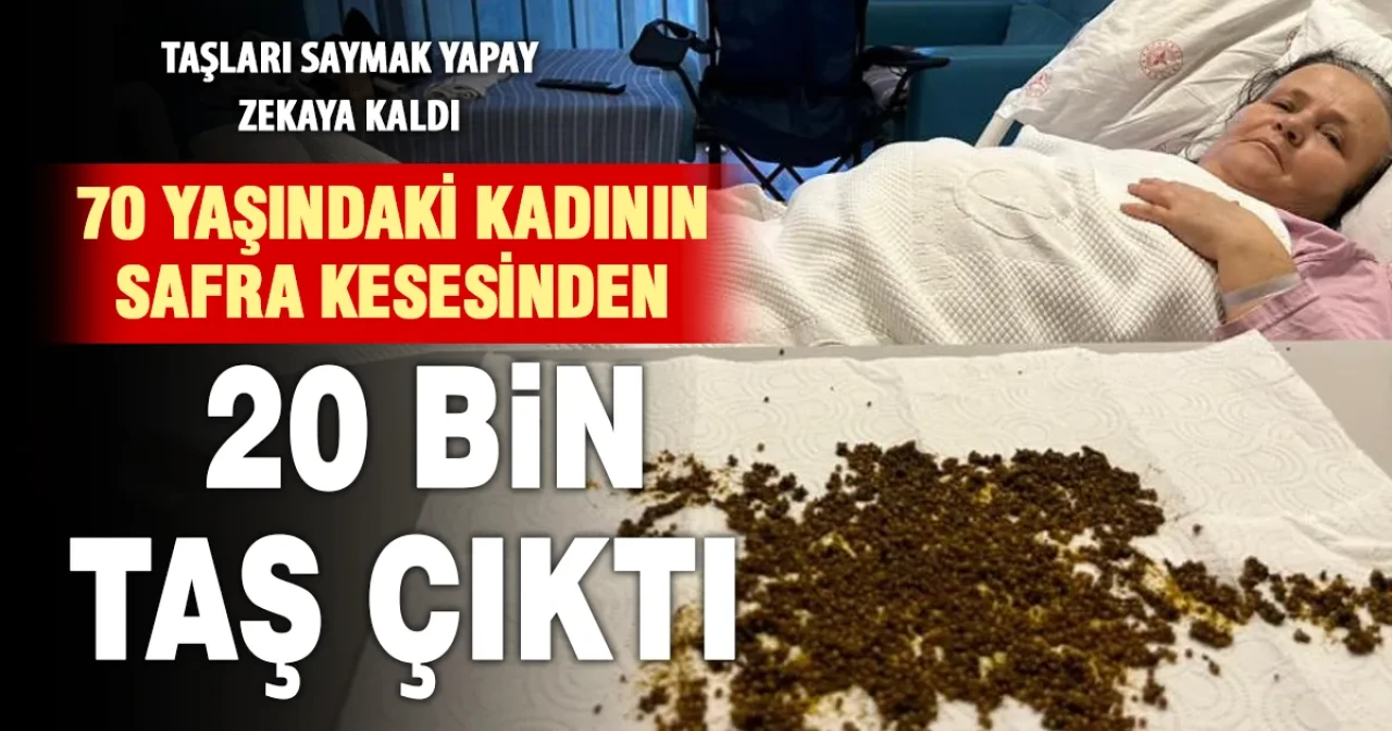 Soma'da İnanılmaz Ameliyat: Safra Kesesinden 20 Bin Taş Çıktı