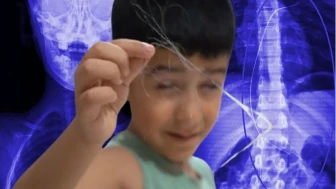 Şırnak'ta 3 Yaşındaki Çocuğun Vücudunda 3 Yıl Sonra 18 cm Kateter Bulundu!