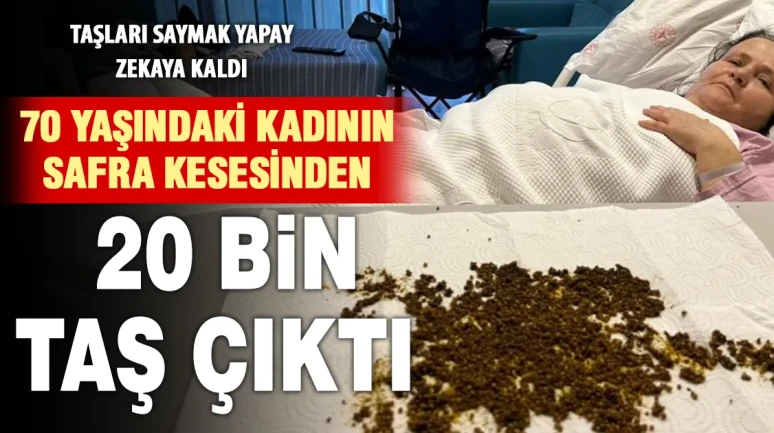 Soma'da İnanılmaz Ameliyat: Safra Kesesinden 20 Bin Taş Çıktı
